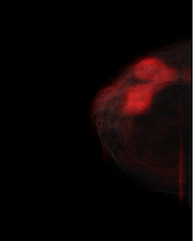 Archived LIBCAD mass-score output for the same mammogram