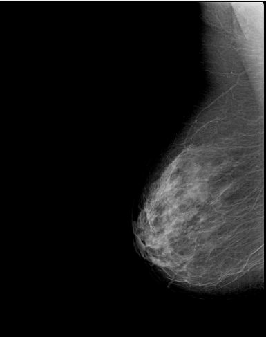 Original lower mammography view for case 1