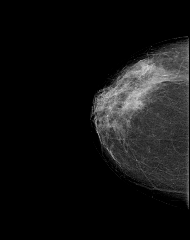 Original mammogram from a fixed historical case