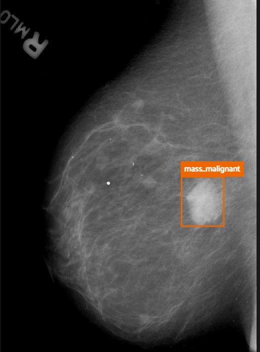 Annotated mammogram before enhancement for additional case 1