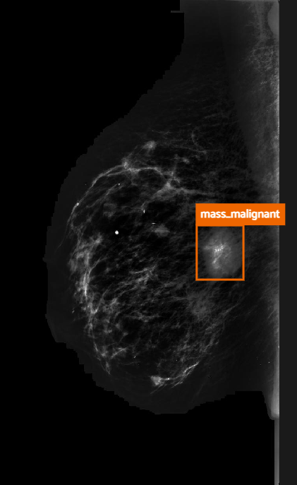 Annotated mammogram after enhancement for additional case 1